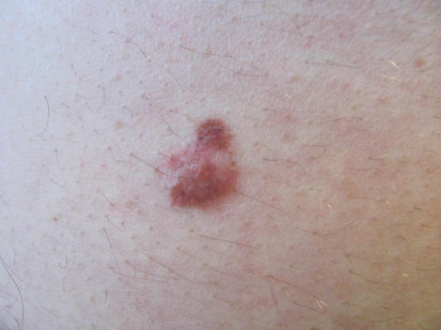 Columbus Skin Surgery Melanoma Lt Lat Lower Back